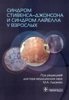 Лысенко, Проценко, Фомина: Синдром Стивенса-Джонсона и синдром Лайелла у взрослых