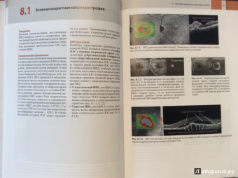 Оптическая когерентная томография сетчатки