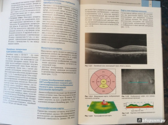 Оптическая когерентная томография сетчатки