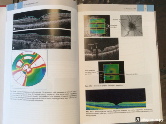 Оптическая когерентная томография сетчатки