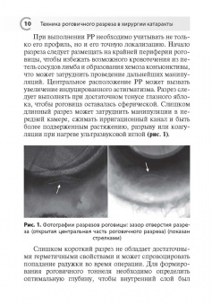 Лоскутов, Кузнецов: Техника роговичного разреза в хирургии катаракты