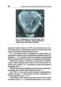 Николаев, Меновщикова, Коварский: Синдром миелодисплазии у детей. Клиника, диагностика, лечение. Руководство для врачей