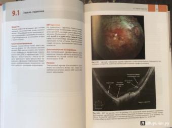 Оптическая когерентная томография сетчатки