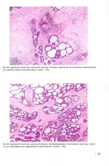 Рак молочной железы. Морфологическая диагностика и генетика. Руководство для врачей