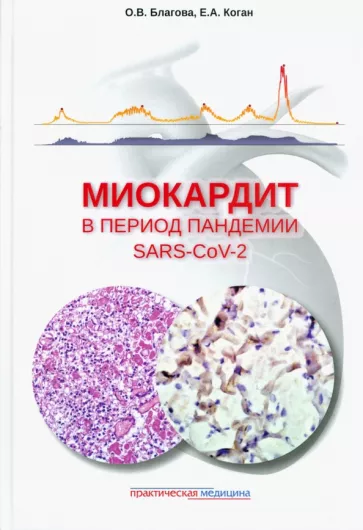 Благова, Коган: Миокардит в период пандемии SARS-CoV-2