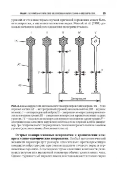 Александр Скоромец: Туннельные компрессионно-ишемические моно- и мультиневропатии